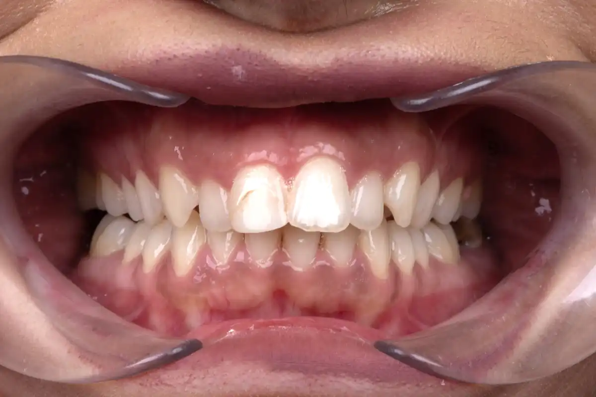 Nachher e.max Veneer Tunesien – Diastema geschlossen harmonisches Lächeln Ergebnis VIP Smile